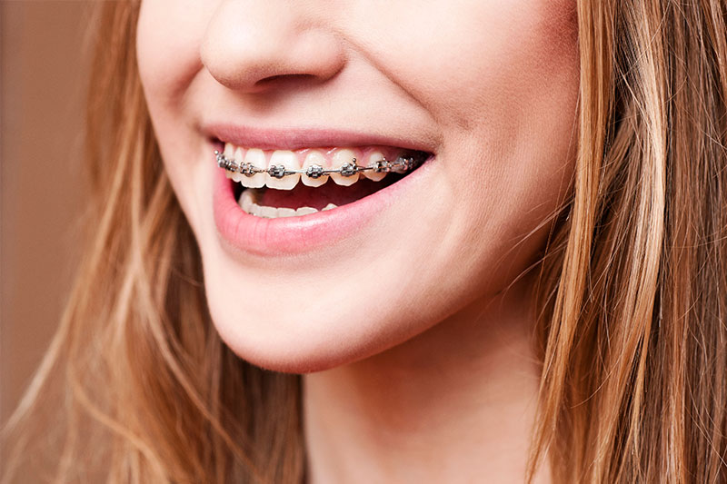 Orthodontics in Moraga